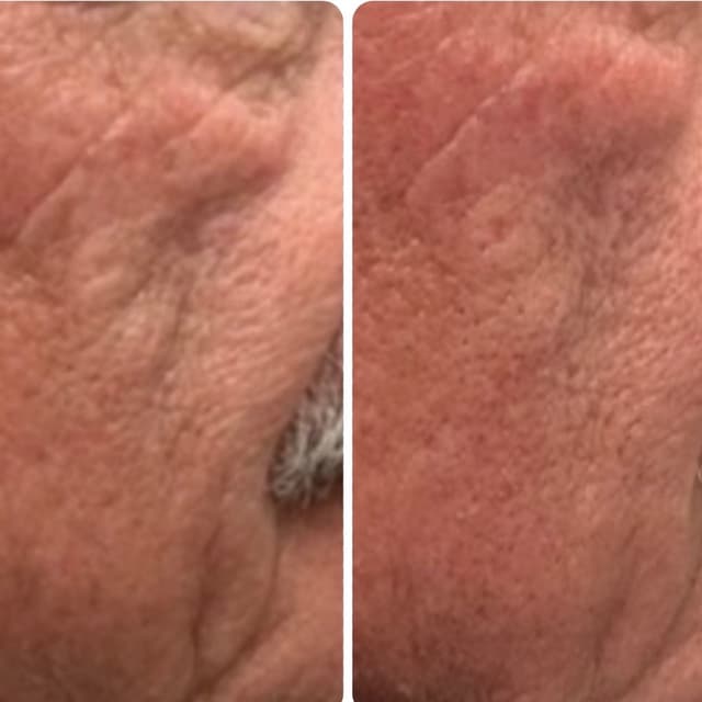 8 Jet Plasma Skin Regeneration at Wild Sage Esthetics in Valdosta, GA