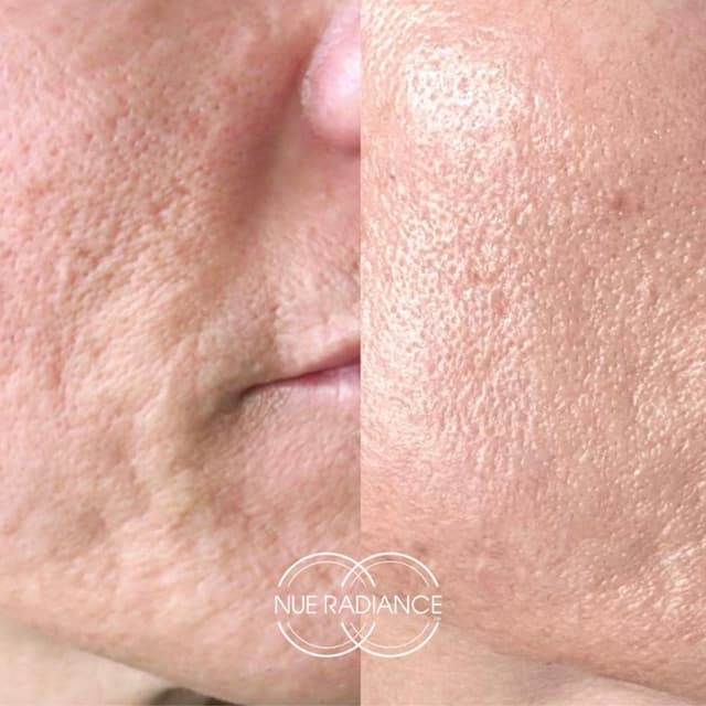 3 Jet Plasma Skin Regeneration at Wild Sage Esthetics in Valdosta, GA