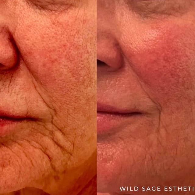 5 Jet Plasma Skin Regeneration at Wild Sage Esthetics in Valdosta, GA