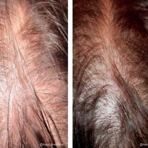 Hair Rejuvenation Package-Full at Wild Sage Esthetics in Valdosta, GA