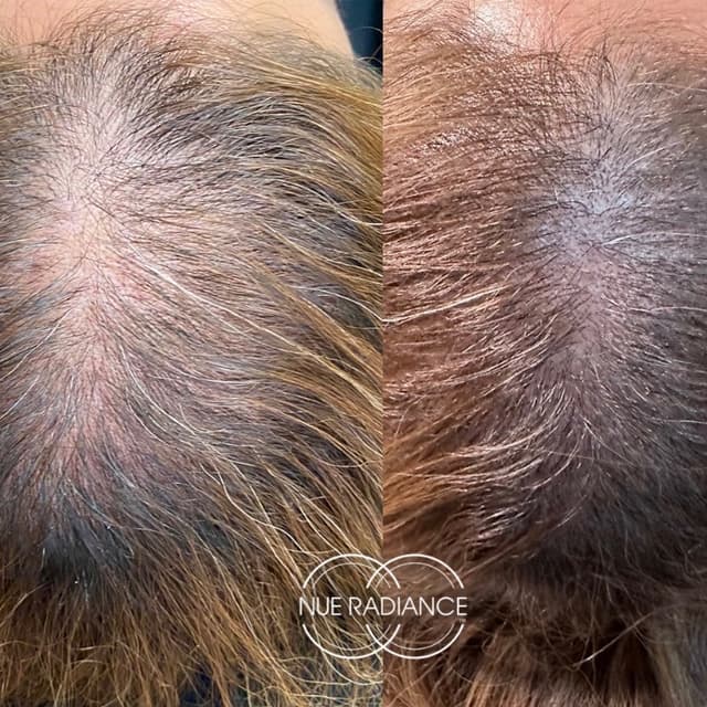 Hair Rejuvenation Package- Partial at Wild Sage Esthetics in Valdosta, GA